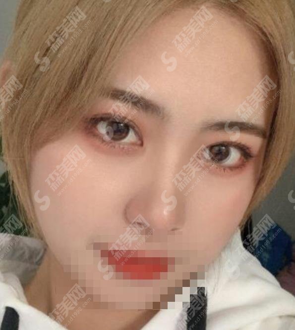 高亮医生怎么样？医生简介+美杜莎双眼皮案例大揭秘！