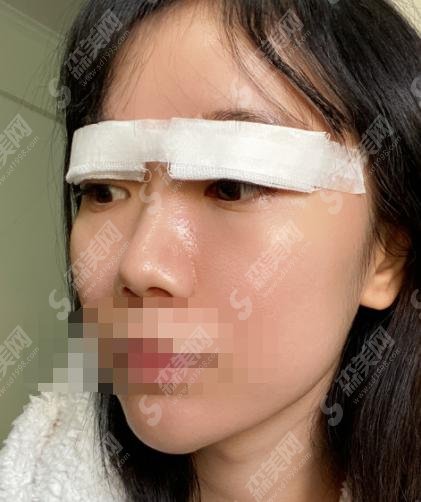 北京协和医院黄渭清怎么样？双眼皮案例分享+医生简介