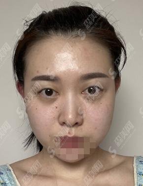 成都八大处值得去么?于晓波医师做的双眼皮果+价格分享