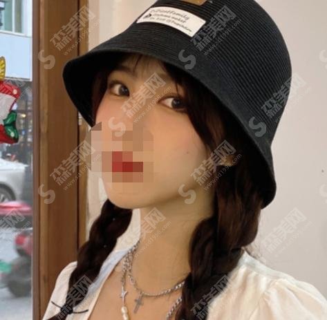 上海九院宋欣怎么样?个人简介+双眼皮案例分享!美的独树一帜!