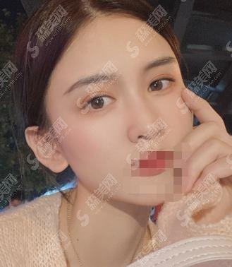 黄良飞医生怎么样？双眼皮果——杭州时光整形口碑给大家介绍！