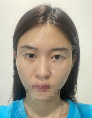 黄良飞医生怎么样？双眼皮果——杭州时光整形口碑给大家介绍！