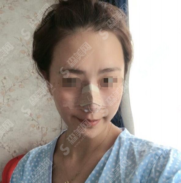北京沃尔冯雁平怎么样？鼻子真实果+医生案例分享给大家！