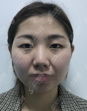 哈尔滨医大一院是三甲的吗？郝立君怎么样？双眼皮手术案例分享