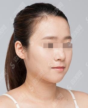 王阳医生怎么样?北京协和/整形案例简直惊艳广大网友!