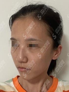 刘彦军医生做的隆鼻果如何！北京八大处整形科+隆鼻价格爆出！