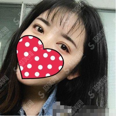 陈文莉医生怎么样?天津眼科医院介绍/整形案例完美展现!