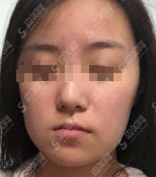 重庆华美潘宝华磨骨怎么样？医生介绍+医生案例+较新价格表