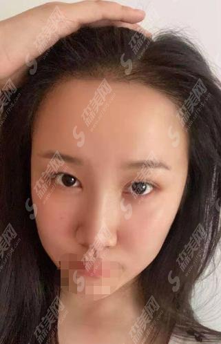 韩愈医生怎么样？植发果+手术案例果分享