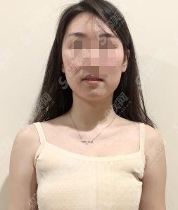 北京八大处穆大力医生怎么样？隆胸果图+医生简介