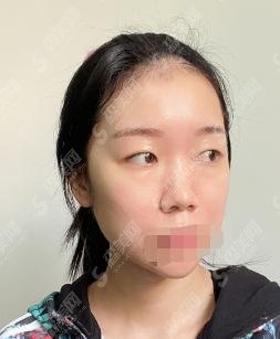 德州天宏整形医院怎么样？双眼皮果，附医生介绍