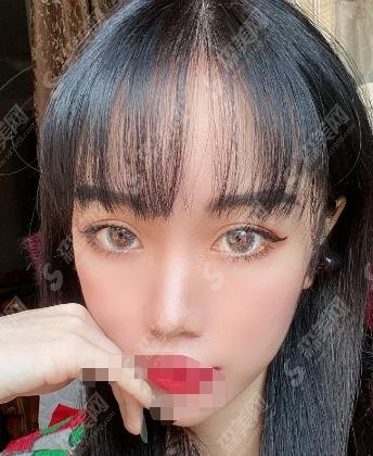 德州天宏整形医院怎么样？双眼皮果，附医生介绍