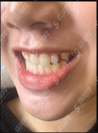 昆明医科大学附属口腔医院好吗？刘娟医生做的牙齿美白果显而易见！