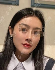 乌鲁木齐恩熙整形医院怎么样?医生怎么样?隆鼻案例分享