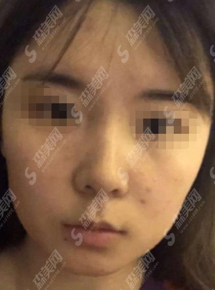 上海解放军411医院整形科怎么样?医生简介和隆鼻案例一览!