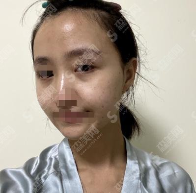 长春中日联谊医院整形科怎么样?祛眼袋果案例图+医院介绍