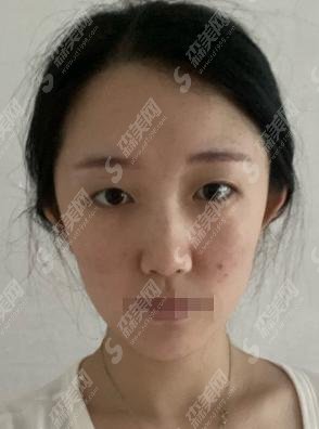 枣阳市第一人民医院整形美容科怎么样？医生怎么样?附相关案例分享