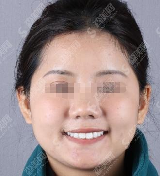 郑州泰康拜博口腔医院是正规医院吗？马贺医生和牙齿矫正恢复果图！