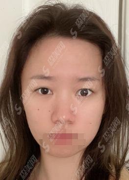 山西省眼科医院怎么样？医生怎么样？附医院做的双眼皮案例！