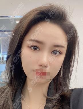 山西省眼科医院怎么样？医生怎么样？附医院做的双眼皮案例！