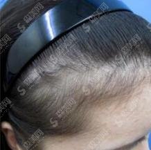 哈尔滨植发医院推荐!哈一大医院实力超群!附医生介绍