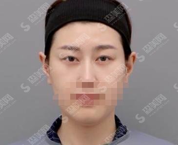 江苏省中医院整形外科黄金龙医生怎么样?医生介绍+双眼皮案例分享