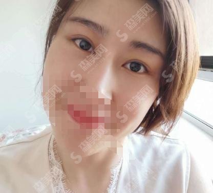 江苏省中医院整形外科黄金龙医生怎么样?医生介绍+双眼皮案例分享