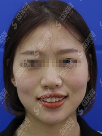义乌市中心医院口腔科如何？牙齿矫正果恢复图+医生信息介绍！