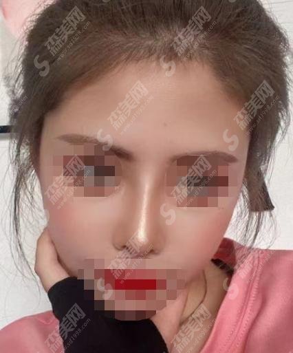 嘉兴曙光整形医院怎么样？医院医生介绍+鼻修复果真实案例揭晓！