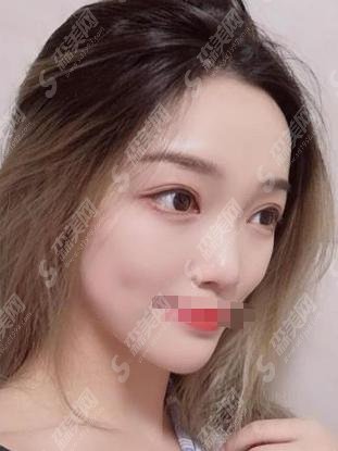 宜昌中心人民医院整形科怎么样?坐诊医生介绍+较新双眼皮案例一览!