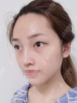 宜昌中心人民医院整形科怎么样?坐诊医生介绍+较新双眼皮案例一览!