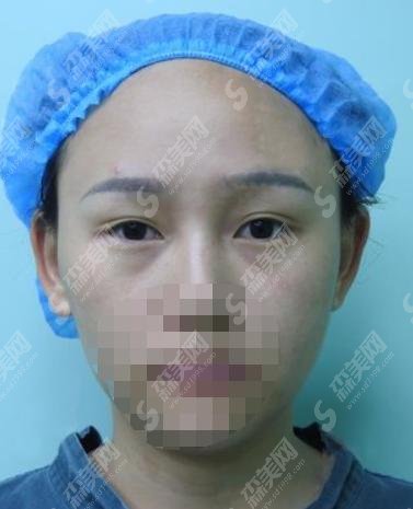 郴州市第一人民医院医学整形美容科怎么样?医生介绍和手术案分享给大家!