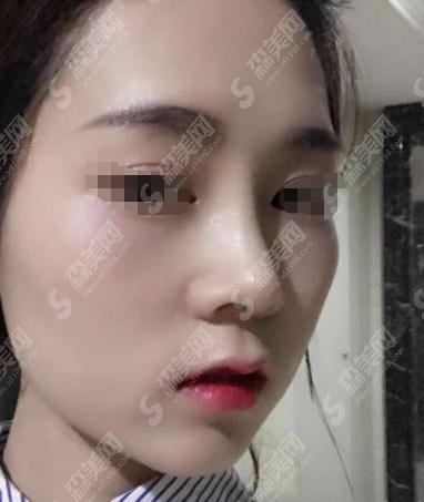 王良发医生技术好不好？做的隆鼻果如何？附北京中月宏整形医院介绍