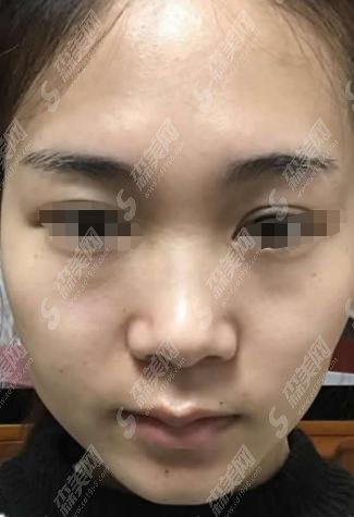 王良发医生技术好不好？做的隆鼻果如何？附北京中月宏整形医院介绍