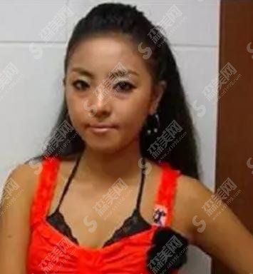 narsha整容?真的有整容吗?