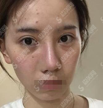 鼻翼缩小手术是十分需要技术的，成都美容整形医院值得推荐附较新价格表！