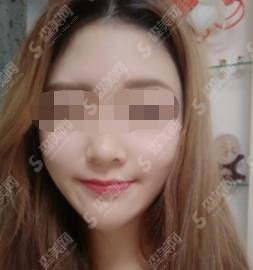 削腮骨手术北大人民医院案例分享让你一看就知晓！