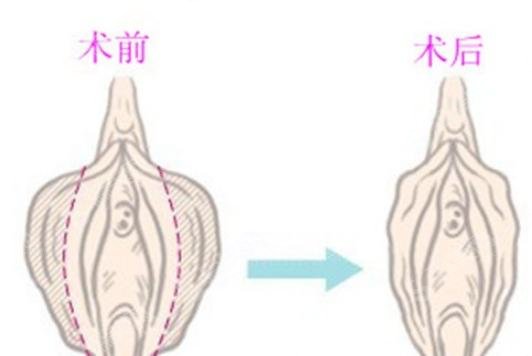 蓝宝石激光祛斑多少钱？恢复果图曝光！