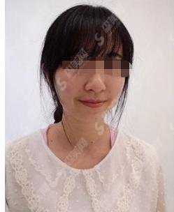 彩光嫩肤手术多少钱?有哪些因素导致的价格?附嫩肤案例分享过程曝光!