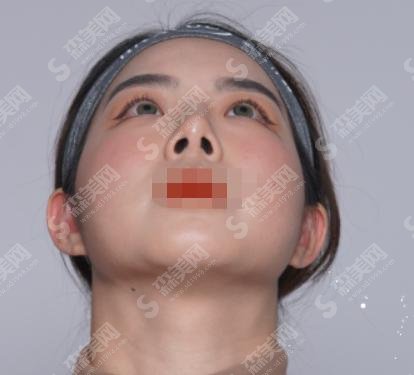 上海yestar整容怎么样？整容医生介绍+整形案例