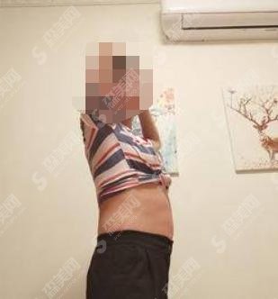 腰部吸脂减肥术?厉害吗?果怎么样?