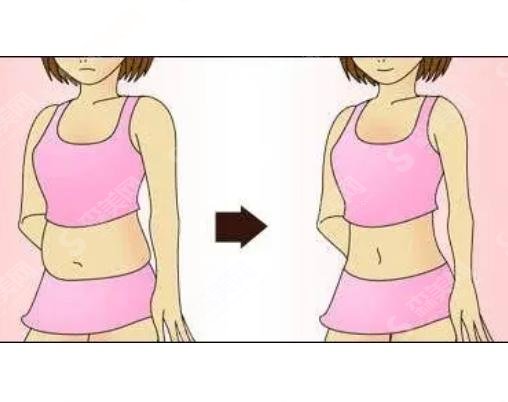 腰部吸脂减肥术?厉害吗?果怎么样?