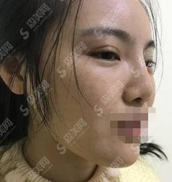 骨粉隆鼻后遗症？骨粉隆鼻后遗症是什么？附骨粉隆鼻取出手术案例