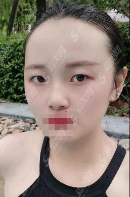 重庆当代整形医院双眼皮好不好？曹美医生技术怎么样？附较新价格表