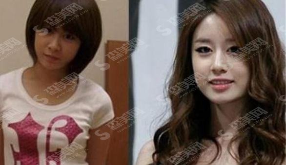 朴智贤整容前后对比！个人资料曝光+项目价格表