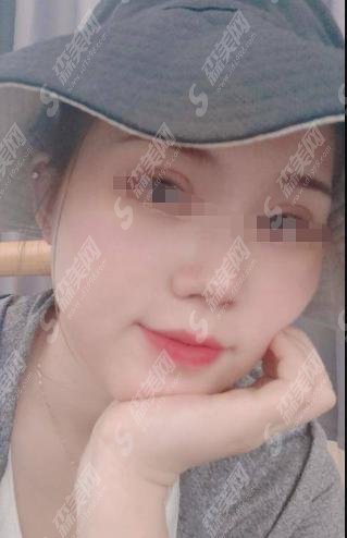 荆州中爱是正规医院吗？杨天赤医生的技术怎么样?附医院做的双眼皮案例+较新整形价目表