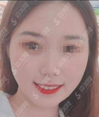 荆州中爱是正规医院吗？杨天赤医生的技术怎么样?附医院做的双眼皮案例+较新整形价目表